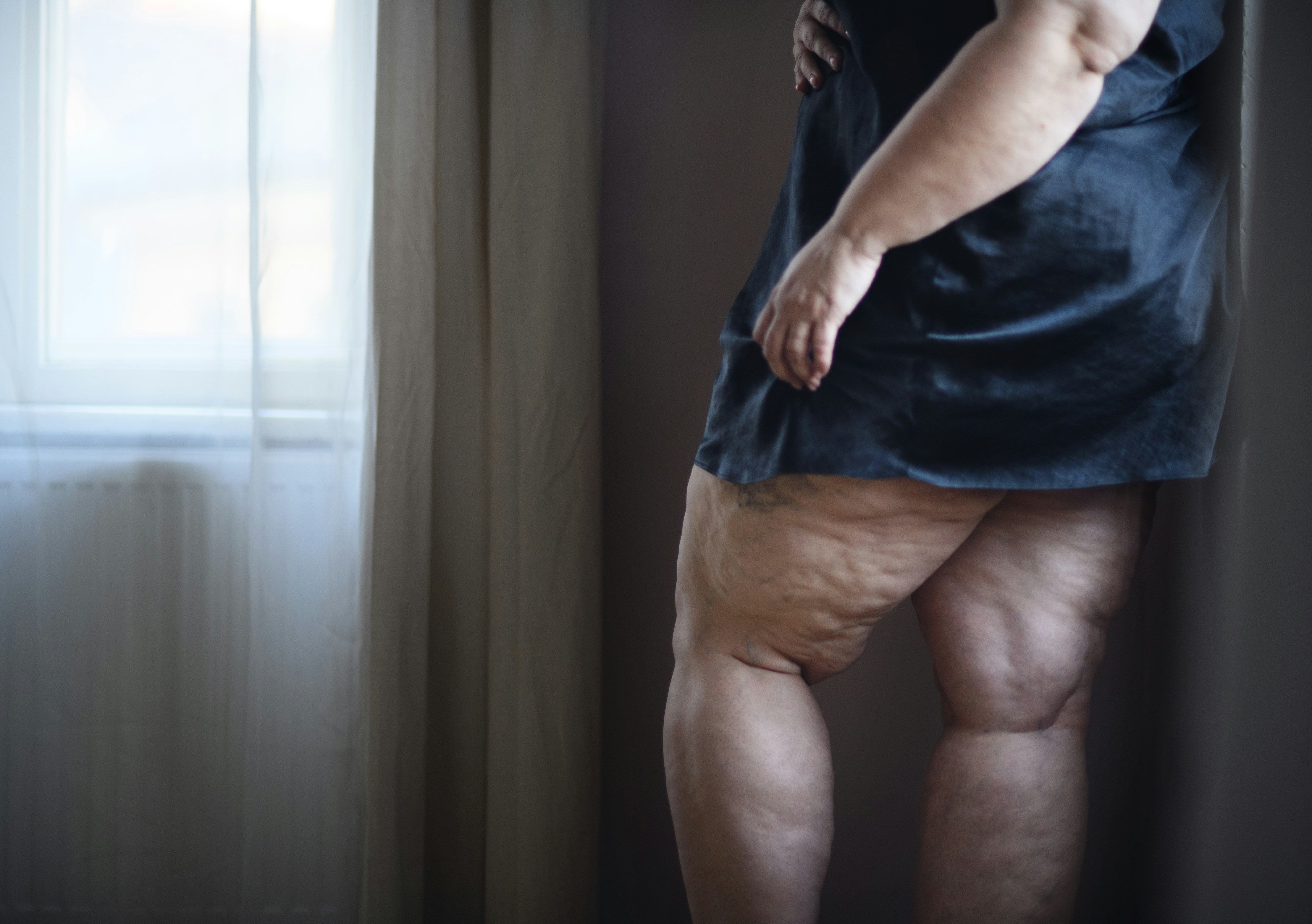 Wassereinlagerungen und die Schilddrüse: Ursachen, Symptome und wichtige Tipps, die du wissen solltest.
